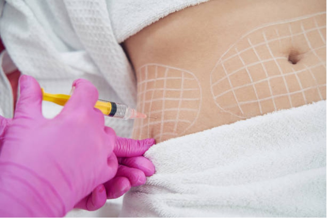Mesoterapia Corporal